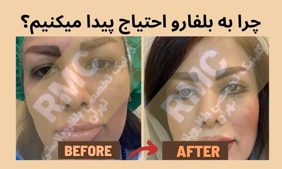 جراحی چرا به بلفارو احتیاج پیدا میکنیم؟