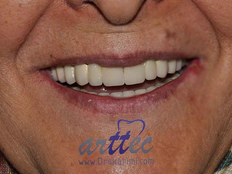 ایمپلنت How to implant front teeth