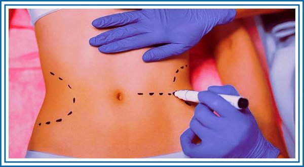 پیکر تراشی شکم و پهلو بدون جراحی آیا ممکن است؟