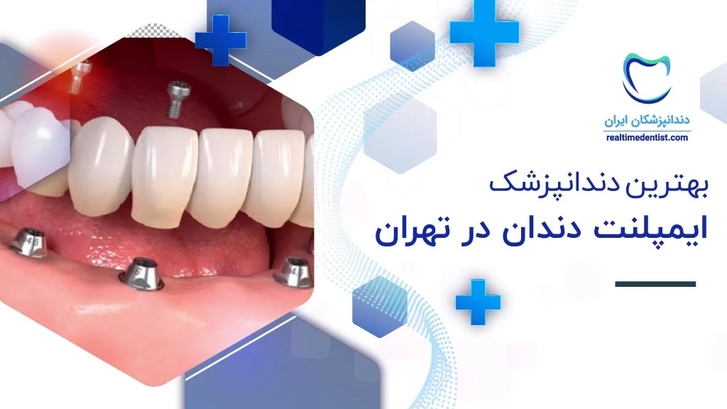 ایمپلنت ایمپلنت | دندان